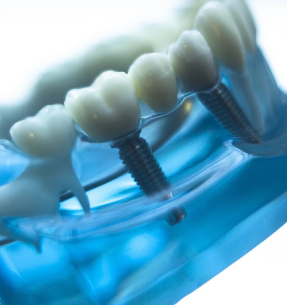 Dental Implant Doctors